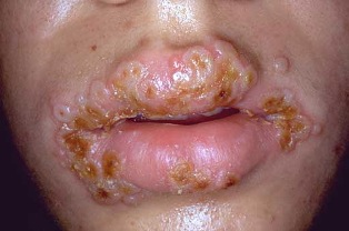 Illustration for article titled Obat Penyakit Herpes